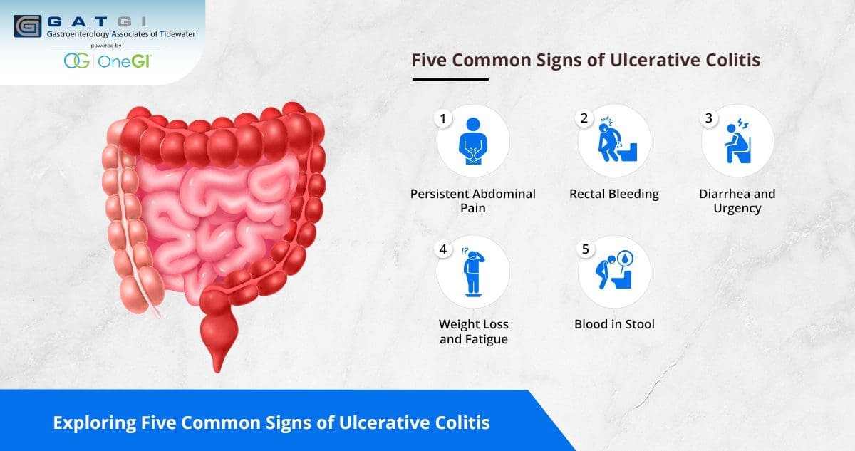 Exploring Five Common Signs of Ulcerative Colitis