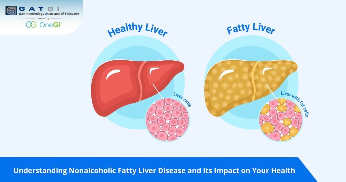 Understanding Nonalcoholic Fatty Liver Disease and Its Impact on Your Health